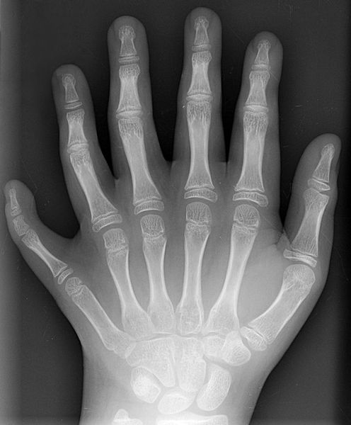 Soubor:Polydactyly 01 Lhand AP.jpg