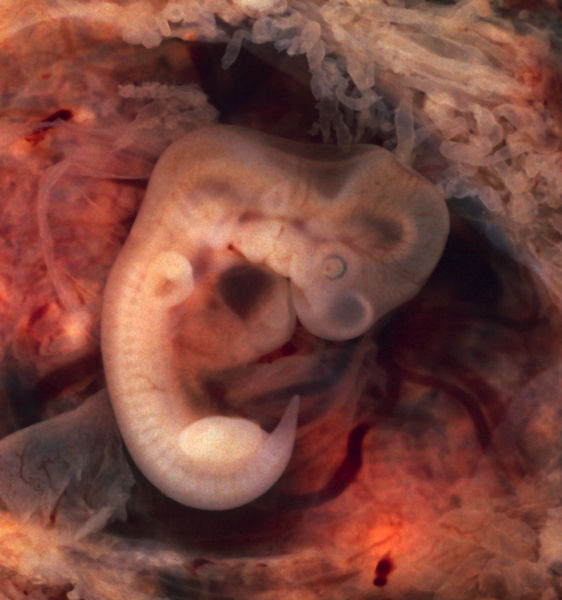 Soubor:Tubal Pregnancy with embryo.jpg