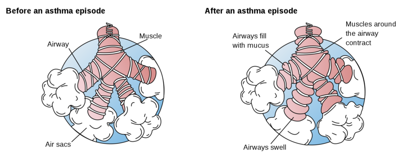 Soubor:Asthma before-after-en.png