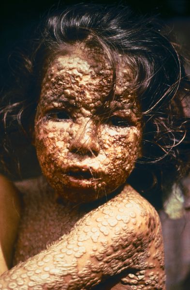 Soubor:Child with Smallpox Bangladesh.jpg