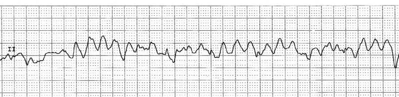 Soubor:EKG VF.jpg