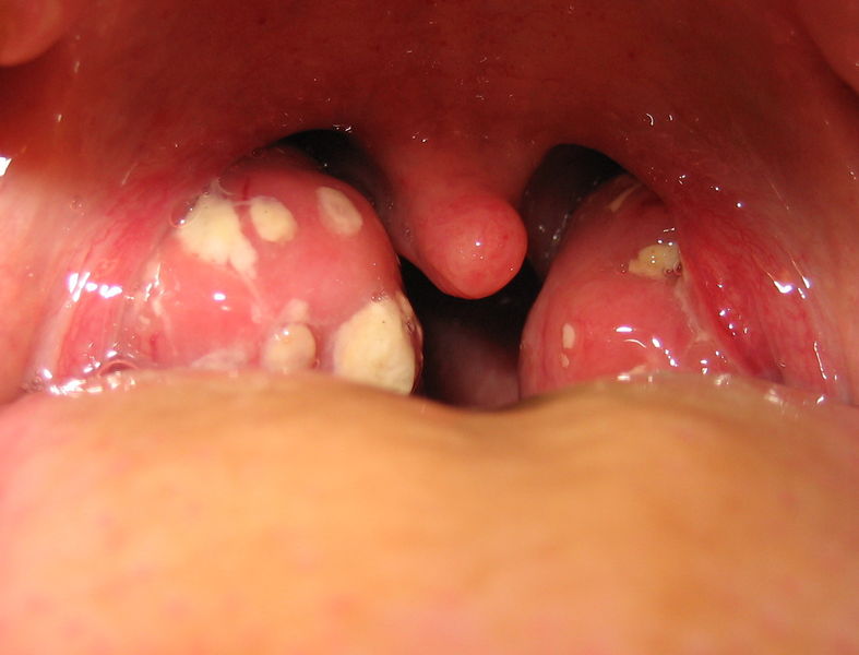 Soubor:Tonsillitis.jpg