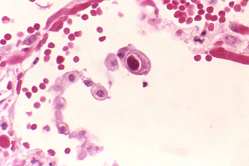 Soubor:Cytomegalovirus 01.jpg