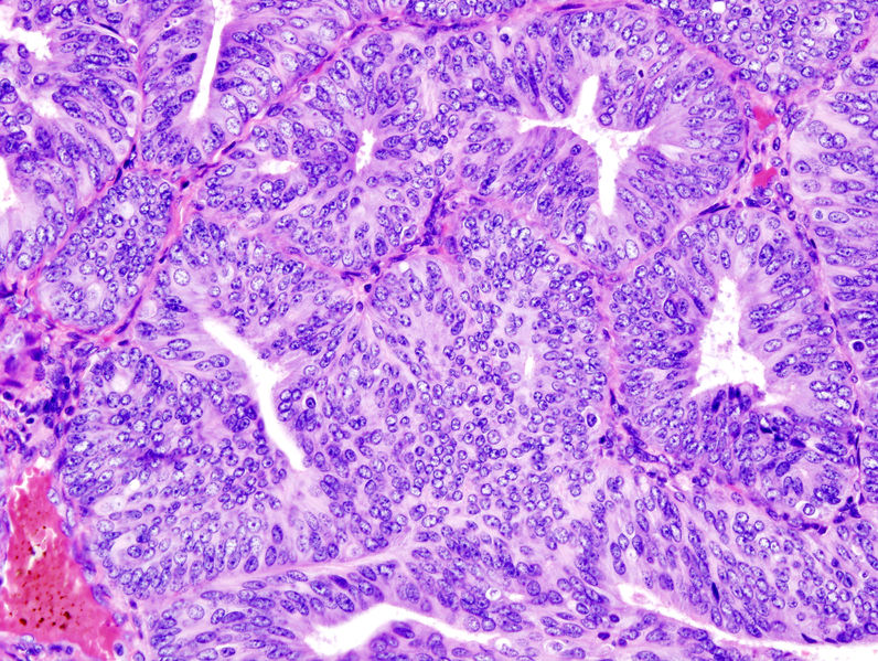 Soubor:Endometrial adenocarcinoma (1).jpg