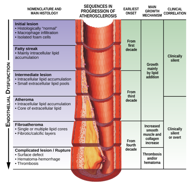 Soubor:Endothelial dysfunction Atherosclerosis.png