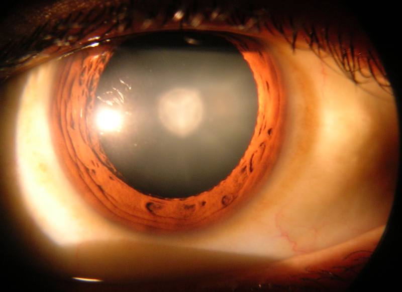 Soubor:Cataract in human eye.png