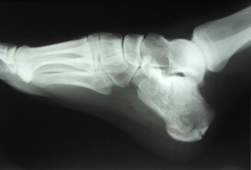 Soubor:Calcaneus Fracture.jpg