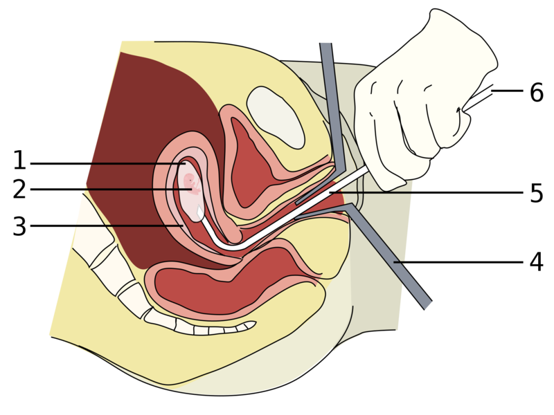 Soubor:Vacuum-aspiration (single).png