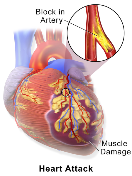 Soubor:Blausen 0463 HeartAttack.png